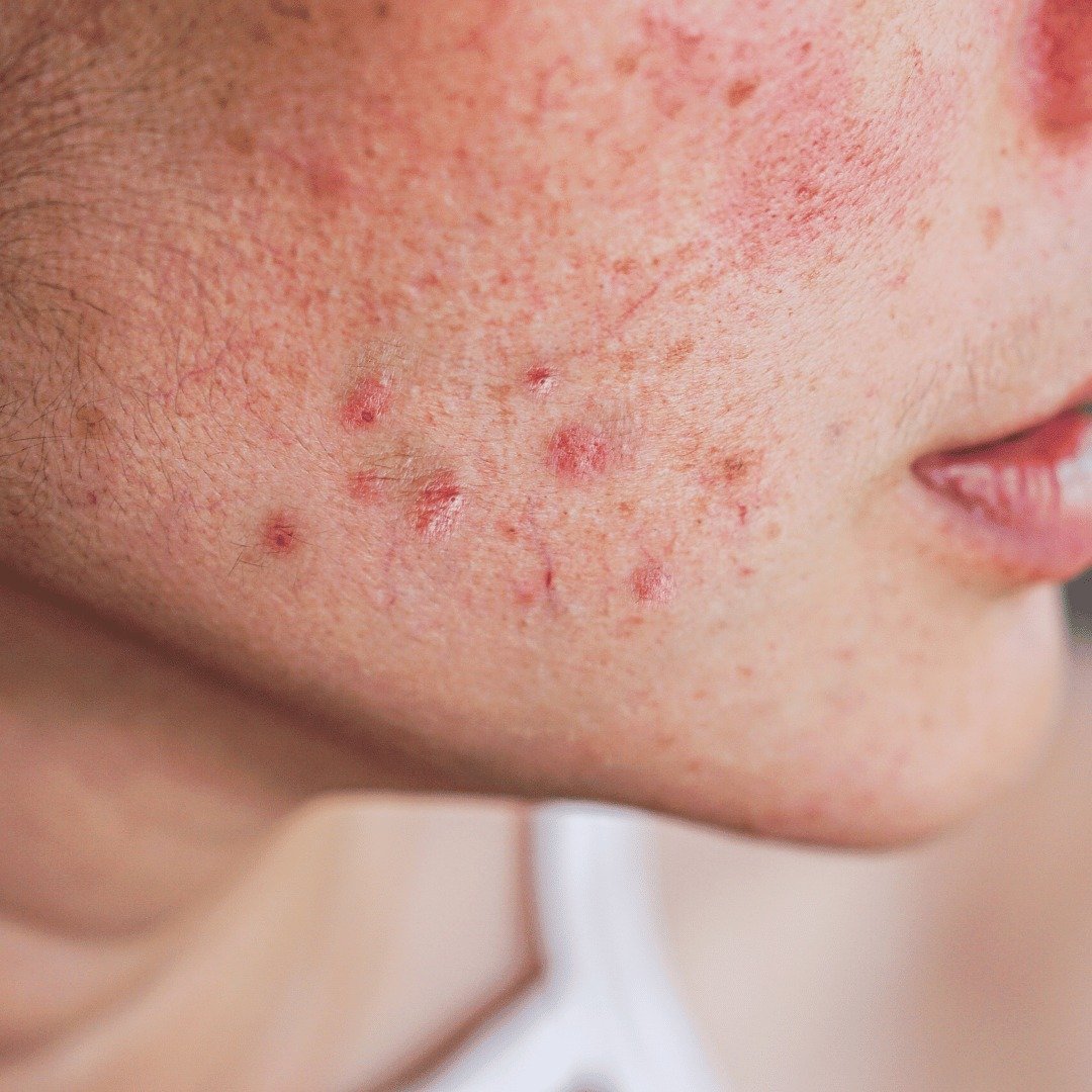 PCOD Blog Image - Combatting PCOS Acne: Expert Insights and Strategies by Dr. Shabnam Sharjil at PCOS Ferticure Clinic.